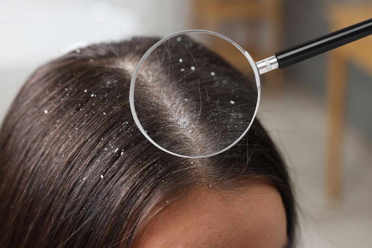 Scalp Health Tips | Dandruff Advice